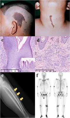 Adult epidermal nevus syndrome with hypophosphatemic osteomalacia treated with burosumab: a case study and literature review